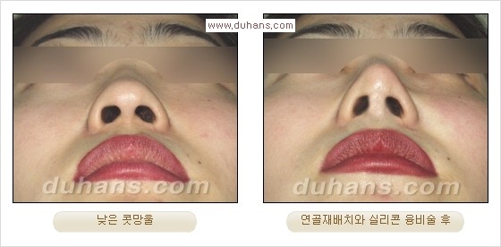 [두한성형외과 경쟁력 코성형] - [코성형을 위한 알로덤(슈어덤) 수술, 실리콘 수술 안내] 관련 이미지 31