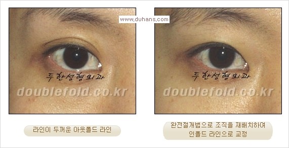 [두한성형외과 경쟁력 눈성형] - [두꺼운 아웃폴드 라인을 인폴드 라인으로 교정] 관련 이미지 7
