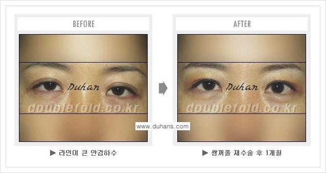 [두한성형외과] - [쌍꺼풀 재수술 푸는 수술을 하고 내원했을 경우의 문제] 관련 이미지 1