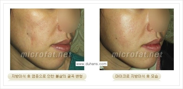 [두한성형외과 경쟁력 지방이식] - [지방이식 부작용 - 지방이식 후 발생한 굴곡현상 교정 안내] 관련 이미지 6