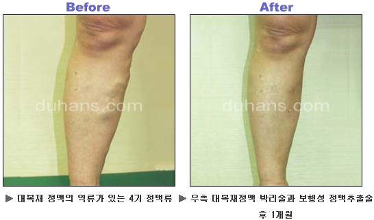 [두한성형외과 정맥류] - [하지정맥류, 정맥확장증, 혈관확장증] 관련 이미지 32