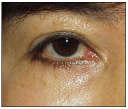 Candidates for Double Eyelid Revision Surgery: Unattractive Double Eyelids, Beautiful Double Eyelids image 25