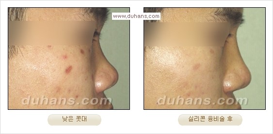 [두한성형외과 경쟁력 코성형] - [코성형을 위한 알로덤(슈어덤) 수술, 실리콘 수술 안내] 관련 이미지 35