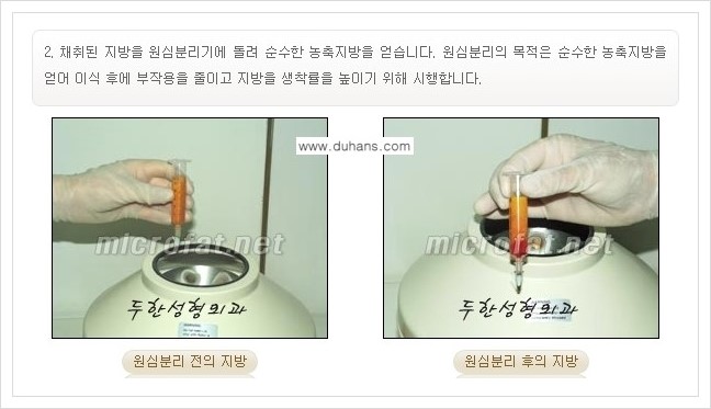 [두한성형외과 경쟁력 미세지방이식] - [귀족수술과 인디언밴드(앞광대주름) 미세지방이식] 관련 이미지 7