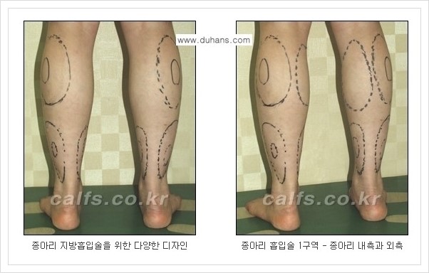[두한성형외과 경쟁력 멀티종아리성형] - [나에게 맞는 종아리성형 방법의 종류 안내 2.] 관련 이미지 10