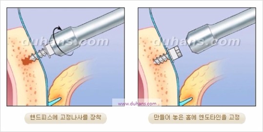 [두한성형외과 주름성형] - [주름교정술 - 강력한 리프팅 파워 엔도타인 리프팅 ] 관련 이미지 36