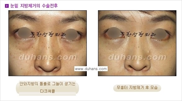 [두한성형외과 젊은 눈매 안검성형] - [눈밑 지방제거의 수술 전후 안내 ①] 관련 이미지 2