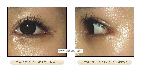 [두한성형외과 경쟁력 있는 쌍꺼풀 재수술] - [뒤트임 수술] 관련 이미지 7