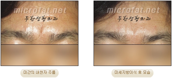 [두한성형외과 자가지방이식] - [미간주름] 관련 이미지 12