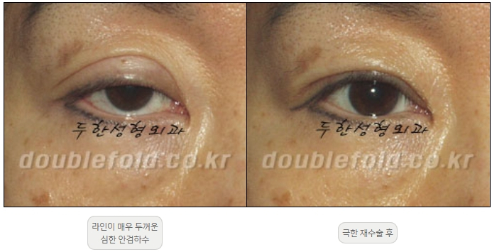 [Duhan Plastic Surgery Double Eyelid Revision] - [Thick Double Eyelid Line] image 54