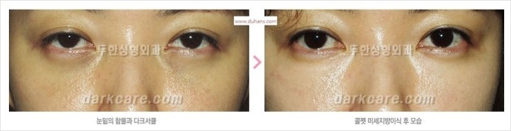 [두한성형외과 경쟁력 눈밑성형] - [눈밑 다크써클 맞춤 치료 방법] 관련 이미지 3