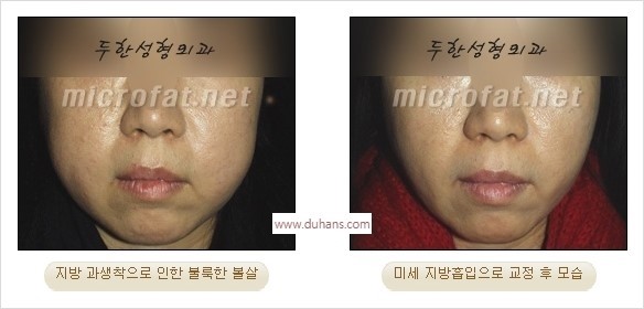 [두한성형외과 경쟁력 미세지방이식] - [지방이식을 이용한 윤곽성형] 관련 이미지 40