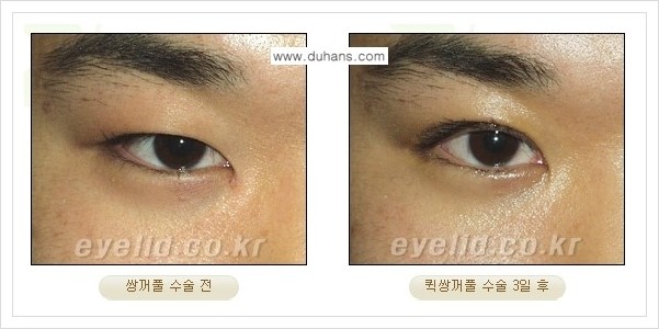[두한성형외과 경쟁력 눈성형] - [퀵쌍꺼풀 수술] 관련 이미지 7