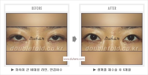 [두한성형외과 경쟁력 눈성형] - [나에게 맞는 어울리는 쌍꺼풀 라인] 관련 이미지 41