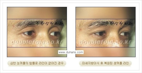 [두한성형외과 경쟁력 쌍꺼풀 재수술(극한 재수술)] - [라인이 풀렸을 경우의 쌍꺼풀 재수술 안내 ②] 관련 이미지 11