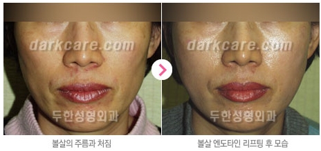 Duhan Plastic Surgery Combo Program - Dark Circles and Lifting image 16