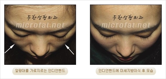 지방이식 두한성형외과 - 입가팔자주름, 인디언주름 지방이식 관련 이미지 34