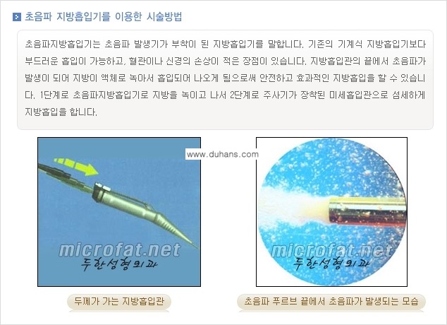 [두한성형외과 겨울엔 지방흡입을] - [통통한 볼살, 두툼한 턱선의 지방흡입 1.] 관련 이미지 4