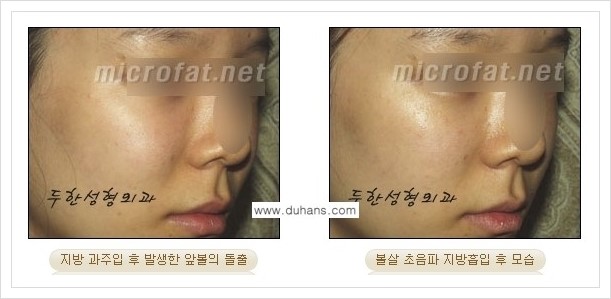 [두한성형외과 겨울엔 지방흡입을] - [볼살, 눈밑, 턱선의 초음파 미세지방흡입 2.] 관련 이미지 7
