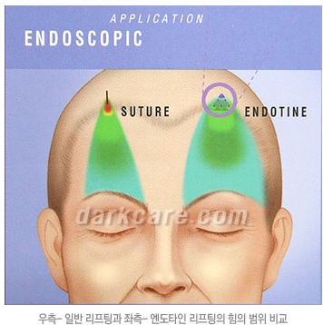 Duhan Plastic Surgery Combo Program - Dark Circles and Lifting image 18