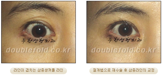 [두한성형외과 눈재수술] - [재수술 방법들] 관련 이미지 19