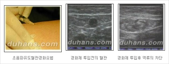 [두한성형외과 경쟁력 정맥류 치료] - [정맥류와 정맥확장증 치료] 관련 이미지 10
