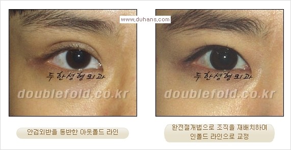 [두한성형외과 경쟁력 눈성형] - [두꺼운 아웃폴드 라인을 인폴드 라인으로 교정] 관련 이미지 5