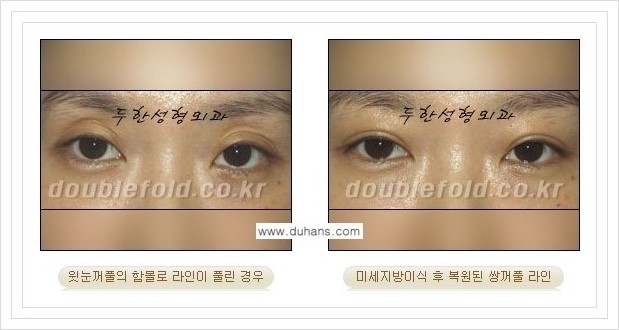 [두한성형외과 경쟁력 눈성형] - [풀린 쌍꺼풀 라인 재수술의 여러 가지 방법 안내] 관련 이미지 10