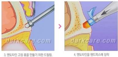 [눈밑수술 두한성형외과] - [다크서클 콤비프로그램] 관련 이미지 148