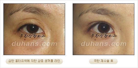 [두한성형외과 경쟁력 쌍꺼풀 재수술 리더 ] - [쌍꺼풀 재수술 과정, 쌍꺼풀 재수술 실패의 원인, 극한 재수술] 관련 이미지 6