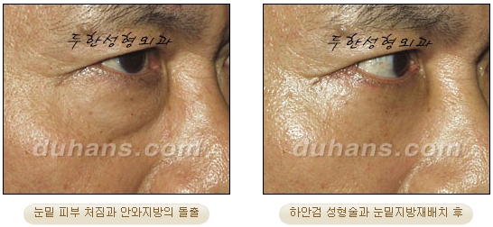 [Duhan Plastic Surgery Ophthalmic Plastic Surgery] - [Lower Blepharoplasty] image 20