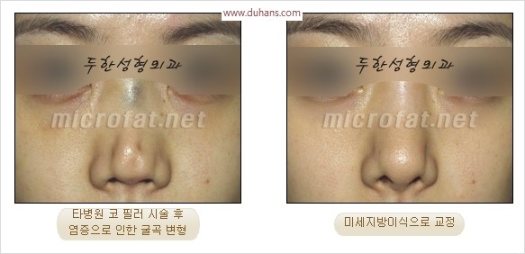 [두한성형외과 경쟁력 코성형 리더] - [자연스럽고 오똑한 콧망울! 코성형 방법]​ 관련 이미지 58