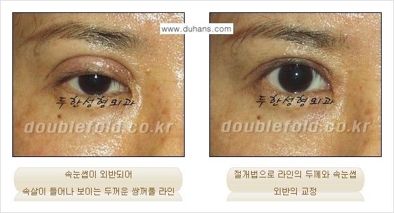 [두한성형외과 경쟁력 쌍꺼풀 재수술, 극한 눈재수술] - [쌍꺼풀 재수술 방법 - 속눈썹 외반] 관련 이미지 5