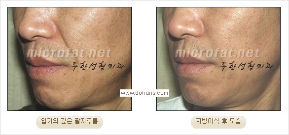 [두한성형외과 경쟁력 주름성형] - [주름 교정을 위한 안전하고 효과적인 미세지방이식] 관련 이미지 10