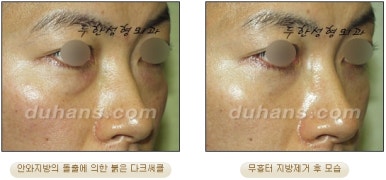 [두한성형외과 지방제거] - [눈두덩이지방제거, 눈밑지방제거] 관련 이미지 24