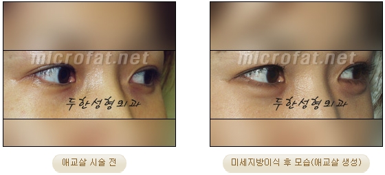 ​[두한성형외과 지방이식] - [애교살] 관련 이미지 25