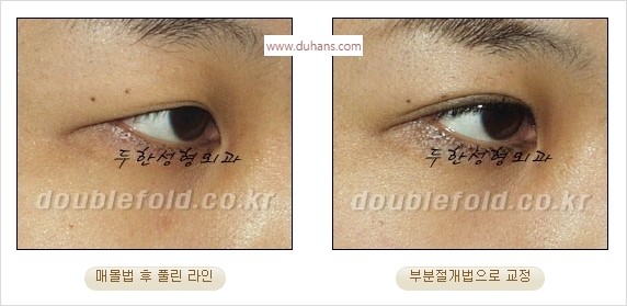 [두한성형외과 경쟁력 쌍꺼풀 재수술] - [풀린 라인 교정(Correction released fold line) 방법] 관련 이미지 8