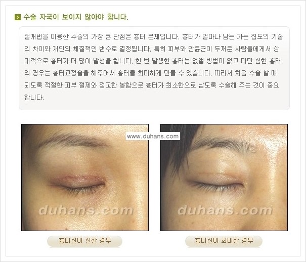 ​[두한성형외과 경쟁력 눈성형] - [자연스럽고 아름다운 쌍꺼풀의 기준] 관련 이미지 3