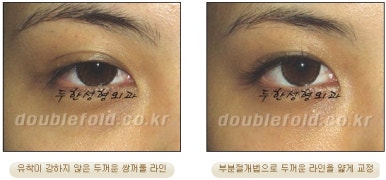 Best Place for Double Eyelid Revision Surgery, Duhan Plastic Surgery - Partial Incision Eye Revision Surgery image 30