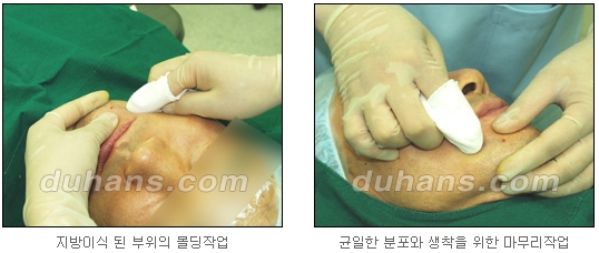 [두한성형외과 얼굴자가지방이식] - [지방이식 과정] 관련 이미지 18