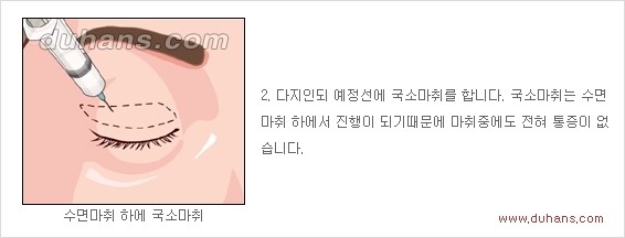 [두한성형외과 경쟁력 안검성형] - [젊고 아름다운 눈매 상안검 성형술 안내] 관련 이미지 2