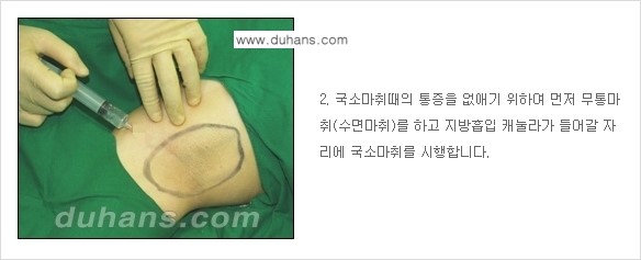 [두한성형외과 성형 FOCUS 지방흡입] - [액취증 - 다한증 초음파 컷터 지방흡입 ④] 관련 이미지 3
