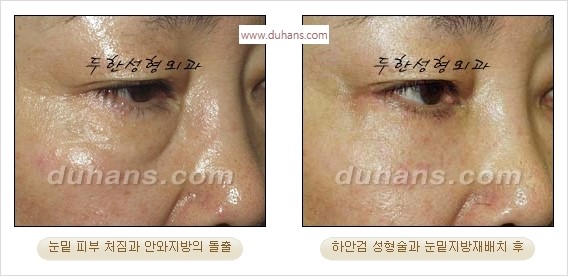 [두한성형외과 경쟁력 안검성형] - [눈밑주름 제거수술] 관련 이미지 21