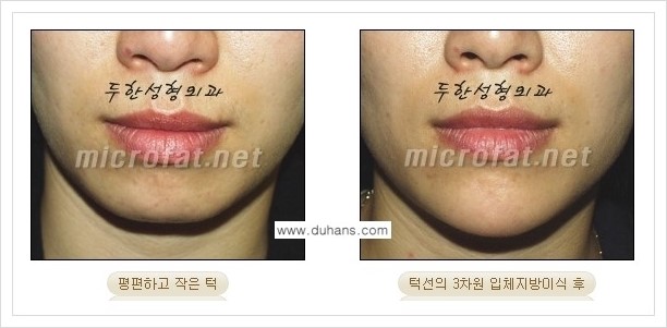 [두한성형외과 경쟁력 안면윤곽 교정] - [미세지방이식으로 무턱, 작은턱, 오목턱, 턱선의 비대칭 교정 안내] 관련 이미지 15