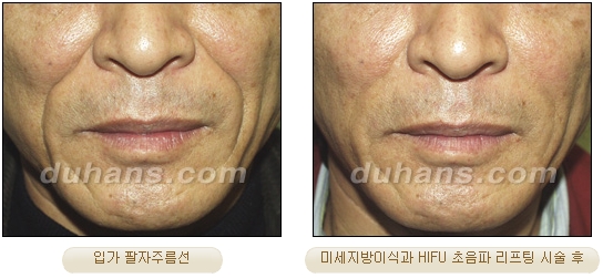 [Duhan Plastic Surgery Lift] - [Double Chin, Drooping Cheeks, Sagging Neck Skin, Wrinkle Improvement] image 30