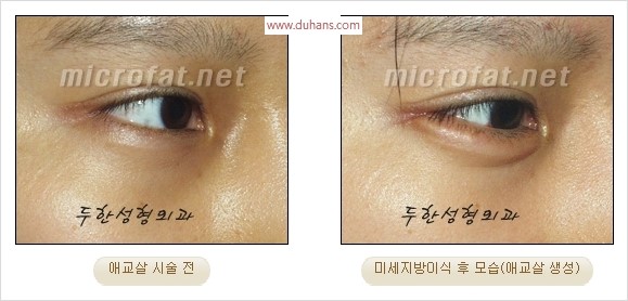 ​﻿[두한성형외과 경쟁력 지방이식] - [눈밑 애교살 시술을 위한 미세지방이식] 관련 이미지 12