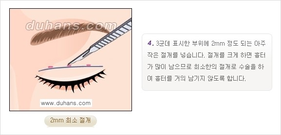 [두한성형외과 경쟁력 눈성형] - [쌍꺼풀 재수술 방법 - 부분절개법(Partial incision method) 과정 안내] 관련 이미지 5