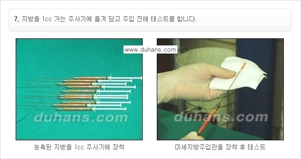 [두한성형외과 경쟁력 미세지방이식] - [부드럽고 아름다운 얼굴선 얼굴 미세지방이식 과정] 관련 이미지 7
