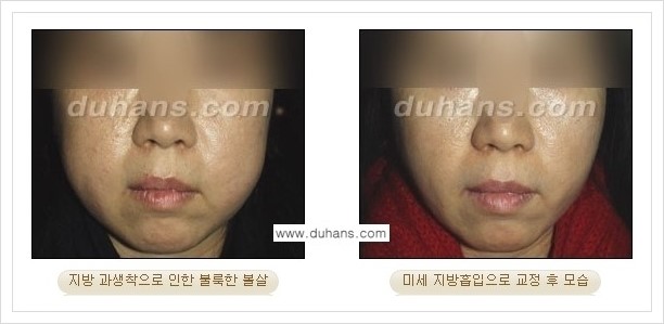 [두한성형외과 경쟁력 얼굴 미세지방이식] - [타병원에서 지방이식 후 굴곡과 과주입 교정 안내] 관련 이미지 11