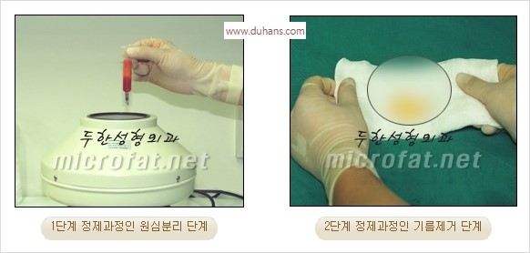 [두한성형외과 경쟁력 안면윤곽 교정] - [자연스럽고 균형있는 턱으로의 복원 미세지방이식과 간편 사각턱 보톡스 안내] 관련 이미지 31